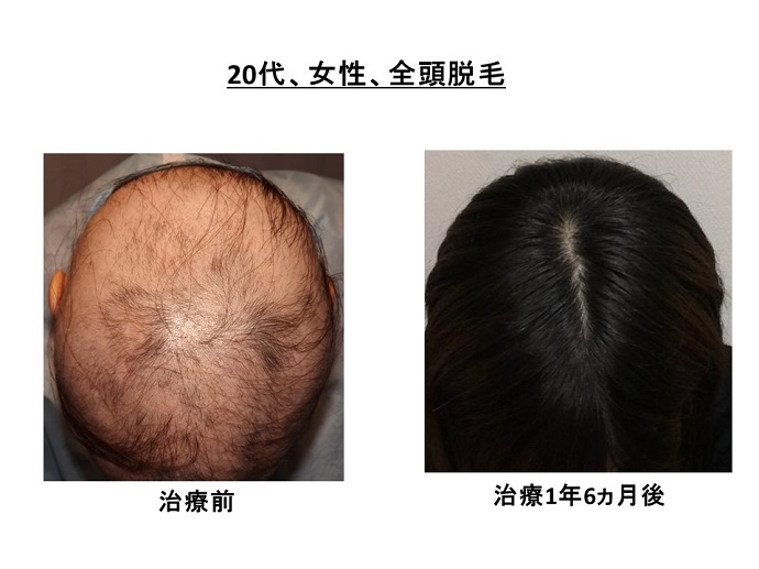 円形脱毛症　病院